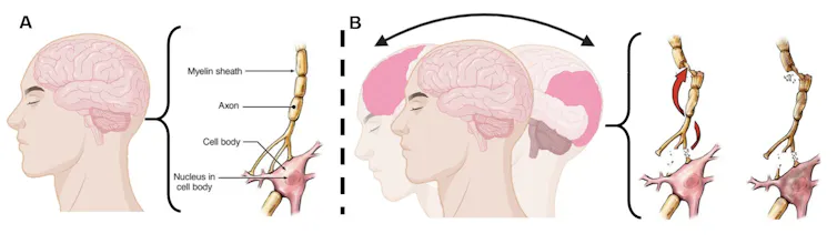 Anatomical diagram showing how concussion damages brain cells.