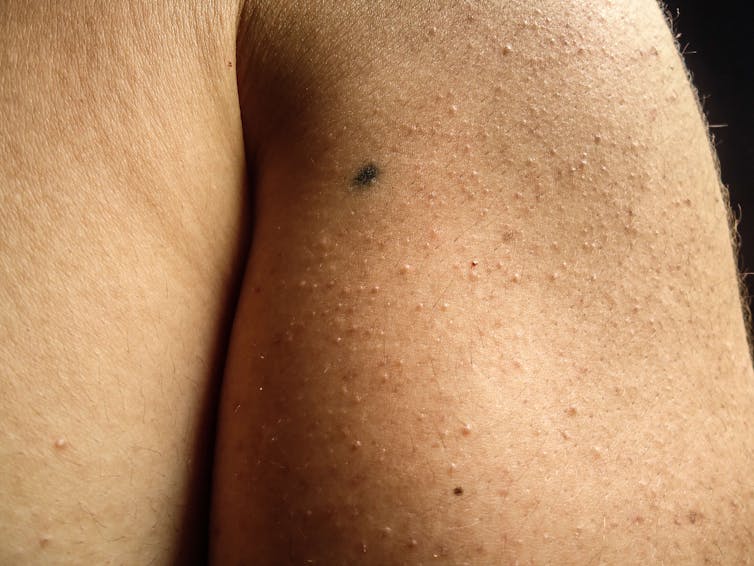 A small radiotherapy tattoo on a person's arm.