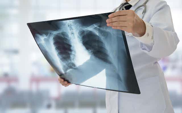 A doctor examines a chest X-ray