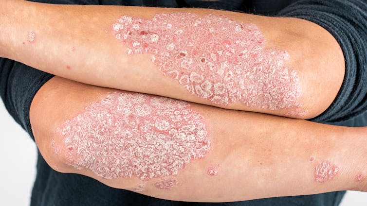 Psoriasis: la solución está en el sistema inmunitario Psoriasis: la solución está en el sistema inmunitario