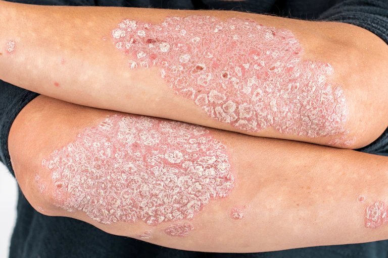 brazos con psoriasis.