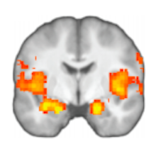 Image of the anterior insula.
