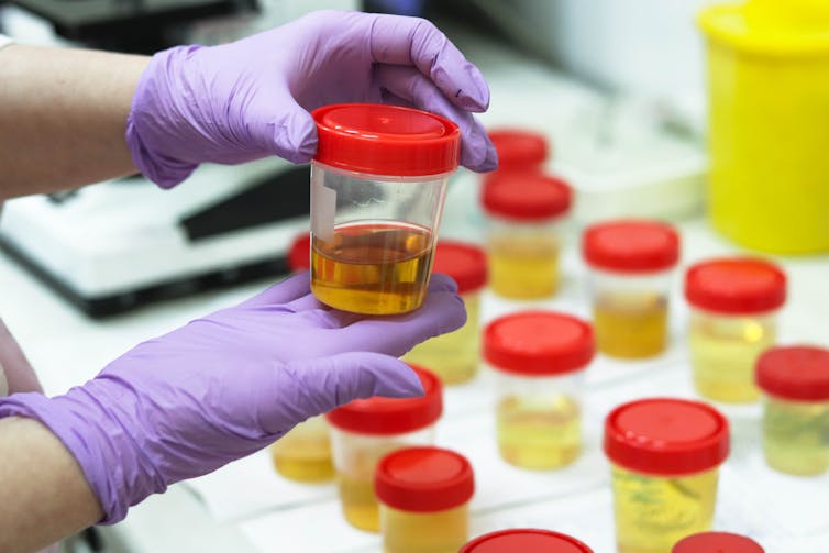 A pair of gloved hands hold a pot containing a urine sample.