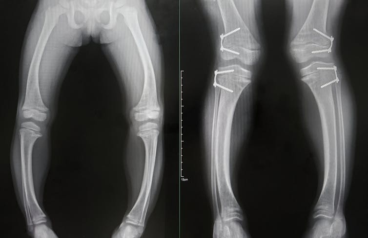 X-rays of the legs of people with rickets.