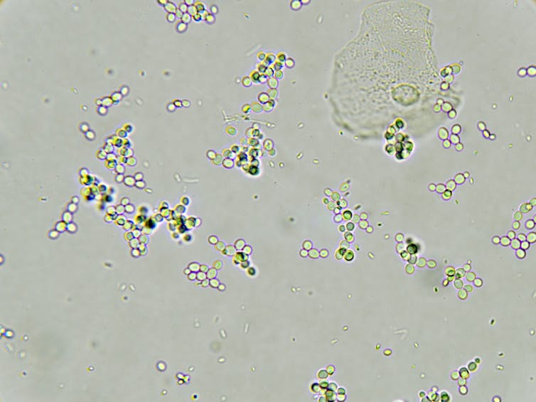 Bacteria in urine indicating a urinary tract infection