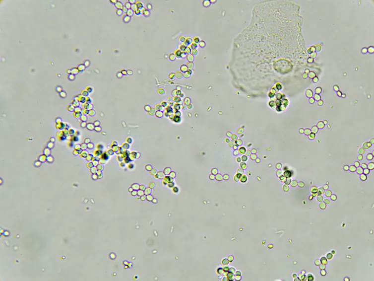 Bacteria in urine indicating a urinary tract infection