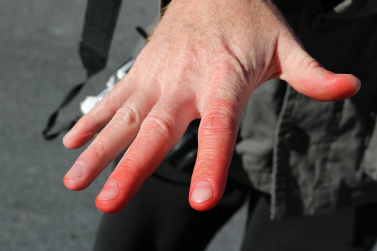 Fingers turned red by frostbite.