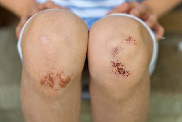 A photo of a woman with scabs and partially healed scrapes on her knees