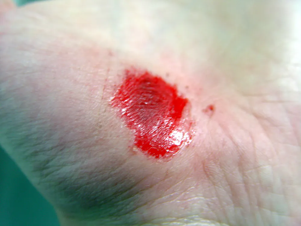 Scrapped Hand A fresh scrape on a palm right after it occured.