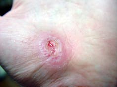 An image of a hand with a partially healed scrape.