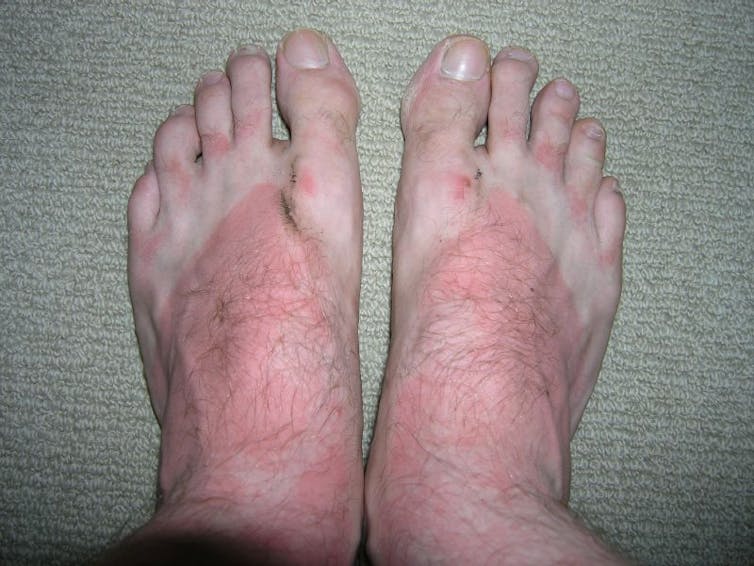 A man's sunburnt feet with white lines showing where the skin was protected by his thong straps.
