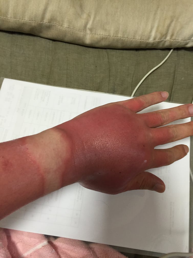 A severely sunburnt, swollen hand with a pale patch where the skin was protected by a watch.