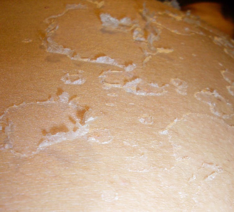 Skin peeling, also called desquamation, after a sunburn.