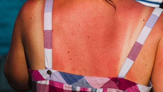 Severe sunburn on a person's back