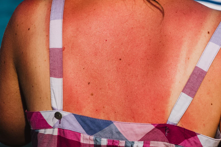 Severe sunburn on a person's back