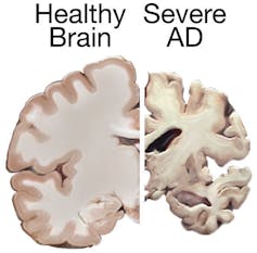 Imagen de cómo se reduce el tamaño del cerebro de un enfermo de alzhéimer.