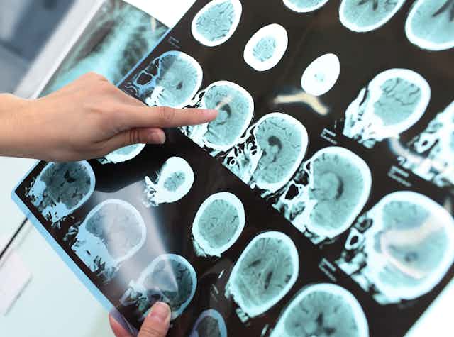 Una mano señala un tomograma en la que se ve un tumor cerebral.