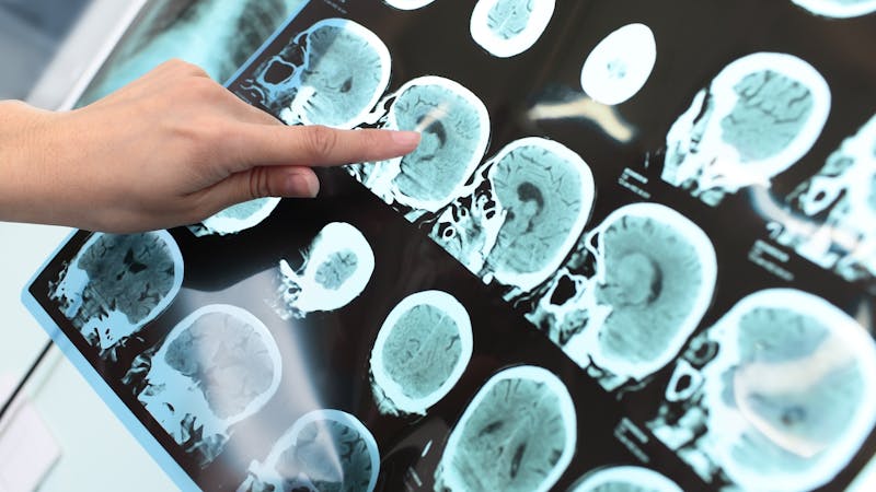 Cuando las metástasis se reducen ‘milagrosamente’: el efecto abscopal Cuando las metástasis se reducen ‘milagrosamente’: el efecto abscopal