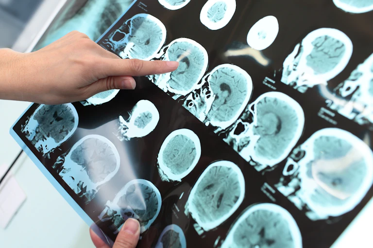 Una mano señala un tomograma en la que se ve un tumor cerebral.