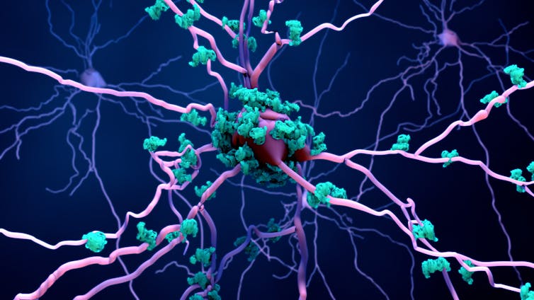 A depiction of a tau protein buildup on a brain neuron.