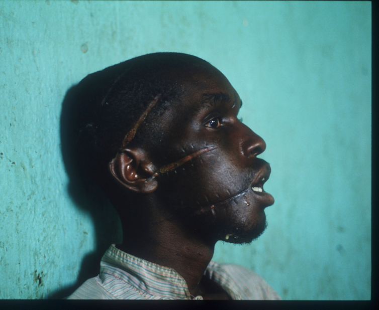 A man with four huge machete scars across his face. Part of his ear is missing.