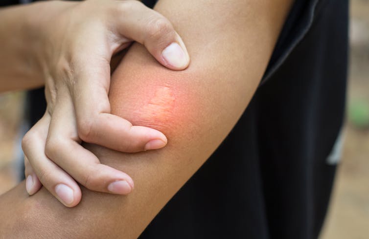 Person squeezing bee sting on arm