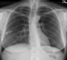 Rayos X e inteligencia artificial para evitar falsos negativos en el diagnóstico de la covid-19 18 file 20210129 20349 12r8i8e.png?ixlib=rb 1.1