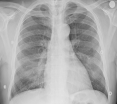 Rayos X e inteligencia artificial para evitar falsos negativos en el diagnóstico de la covid-19 19 file 20210129 20398 1hoi6kj.png?ixlib=rb 1.1