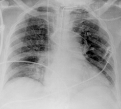 Rayos X e inteligencia artificial para evitar falsos negativos en el diagnóstico de la covid-19 20 file 20210129 20450 12wo6au.png?ixlib=rb 1.1