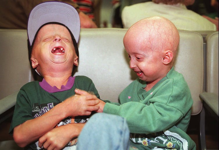 Two people with progeria.