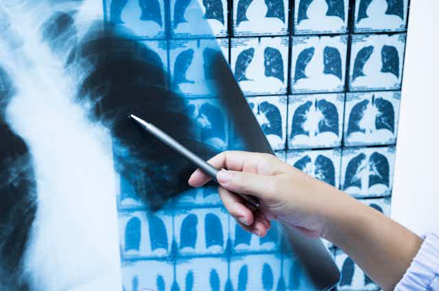 Una mano señala con un puntero una radiografía de tórax