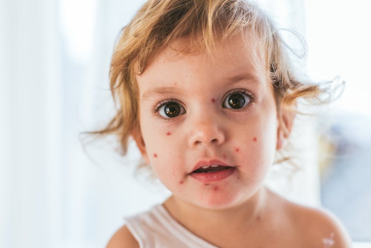 A young girl with chicken pox