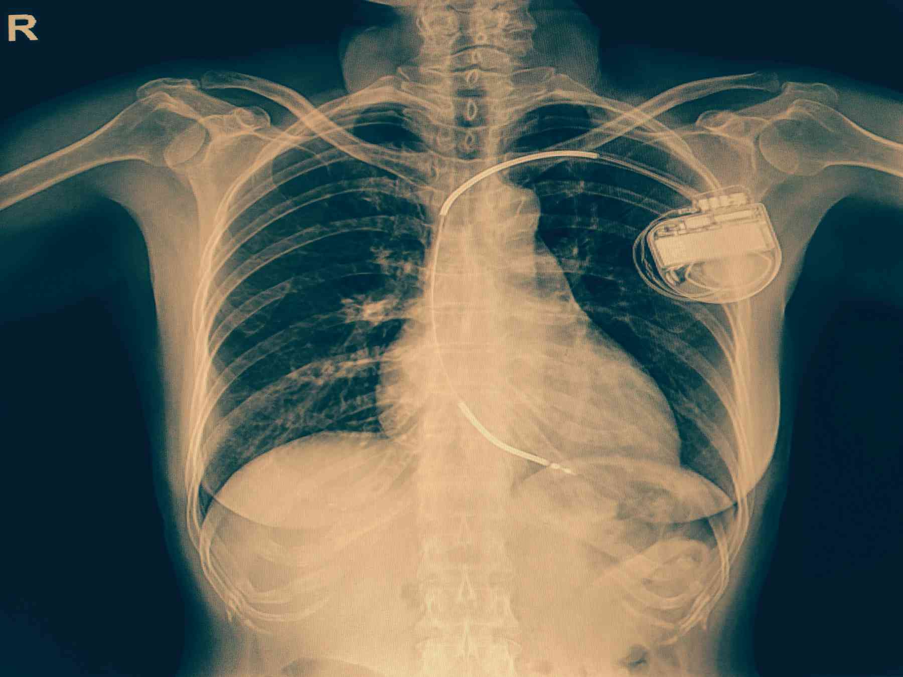 Got an implantable defibrillator or a pacemaker? Keep your iPhone 12 in ...