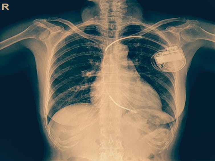 An x-ray showing an implantable cardioverter defibrillator.