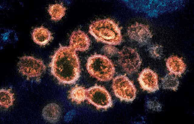 An electron microscope image of SARS-CoV-2 viral particles isolated from a patient