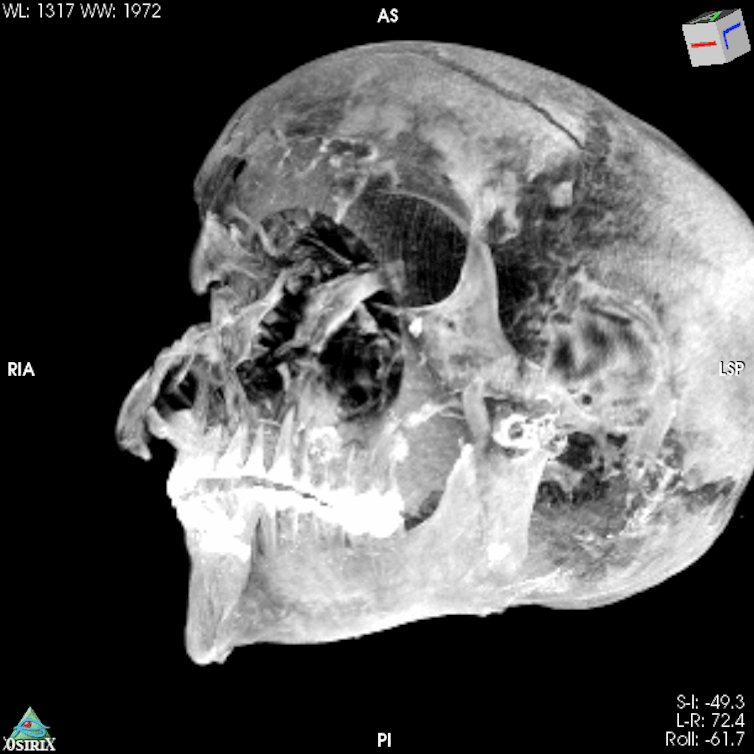A black and white scan of a skull showing damage.