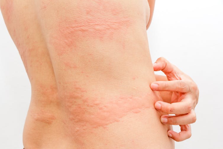 A woman with hives on the trunk of her body.