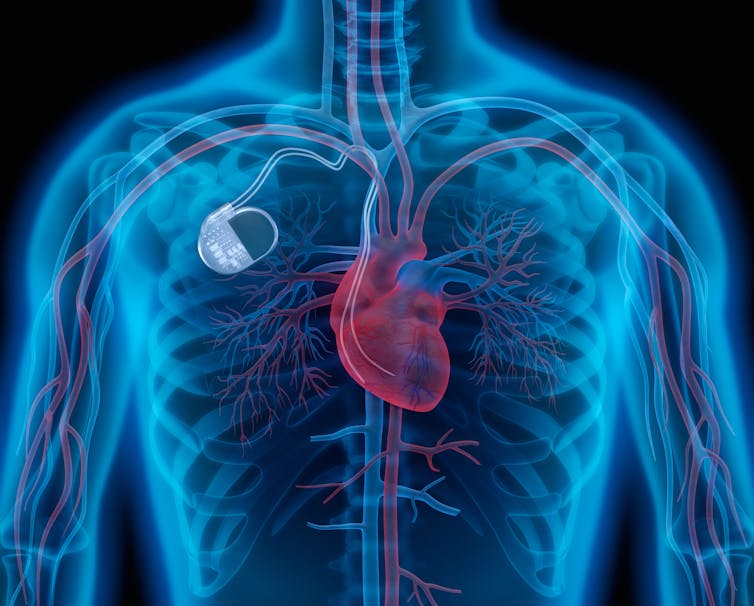 An illustration of an artificial pacemaker inside the body.