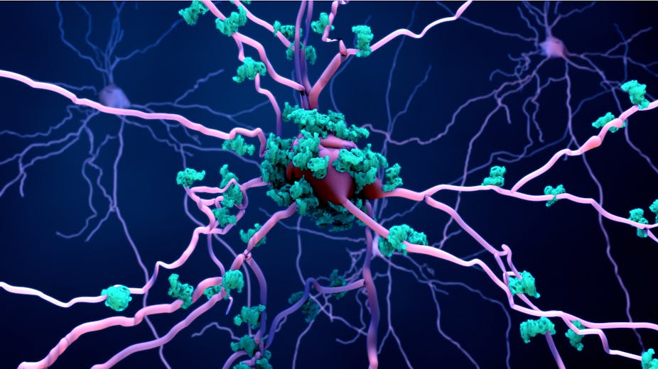 A digital rendering of amyloid plaques built up on a brain cell.