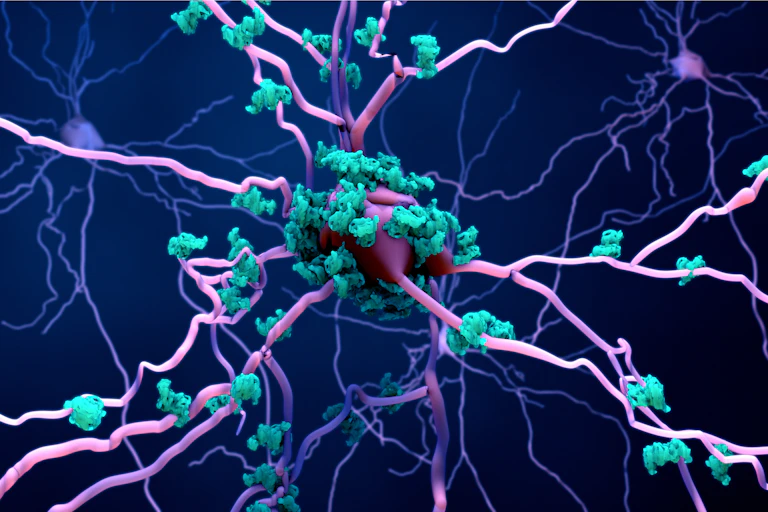 A digital rendering of amyloid plaques built up on a brain cell.
