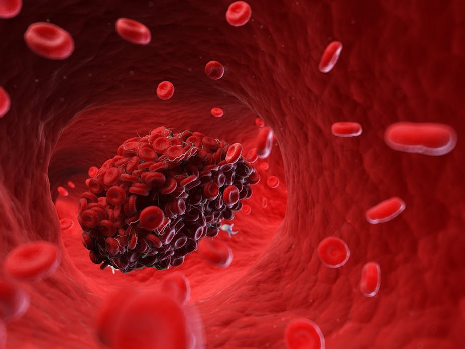 Blood clots five reasons they may happen