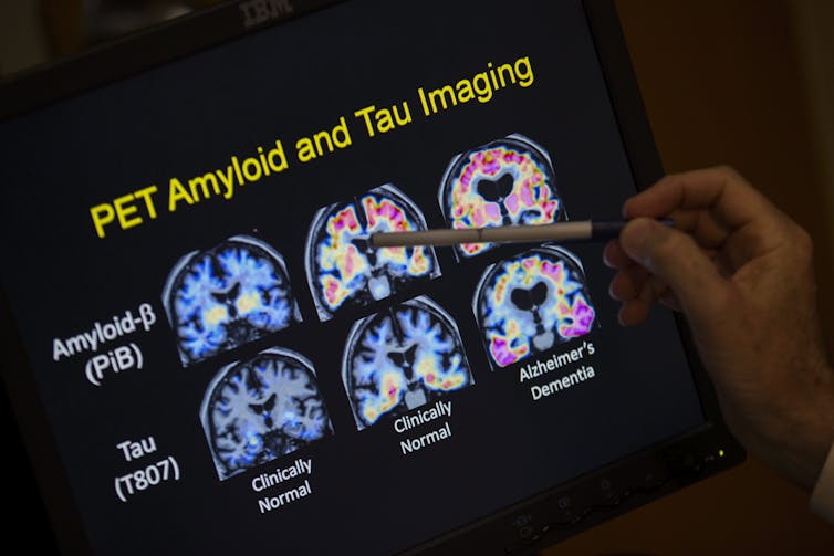 PET scan of brain images