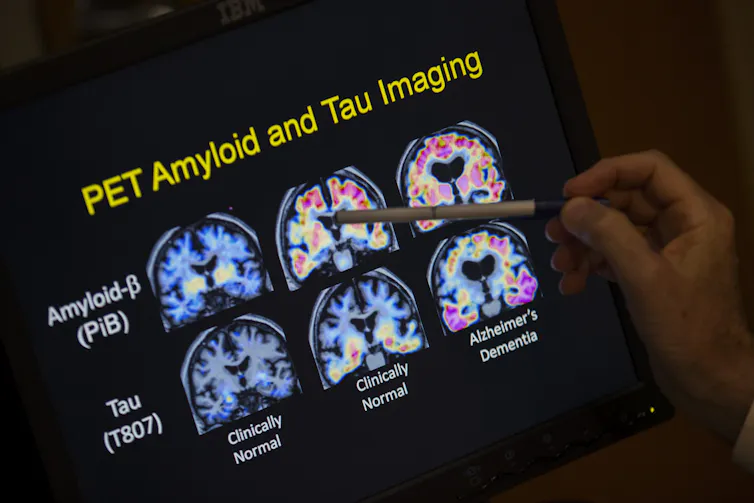 PET scan of brain images