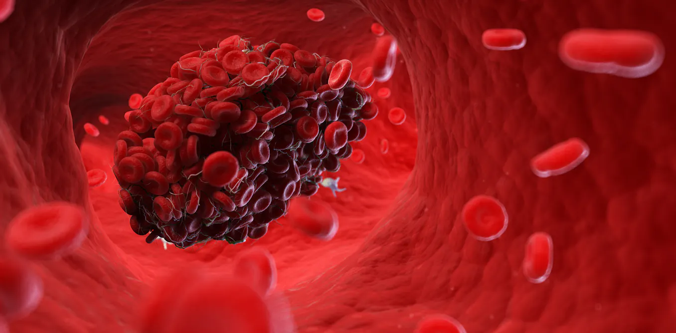 Coágulos sanguíneos y covid-19: cinco factores de riesgo
