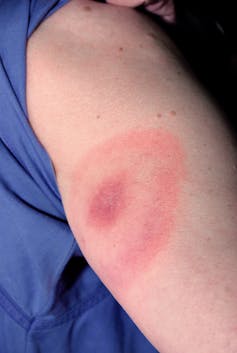 A bullseye-shaped rash on a woman's upper arm