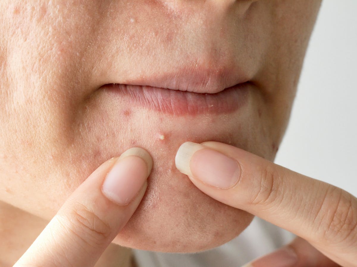 El Estres No Es El Responsable Del Acne Pero Ayuda A Su Aparicion El Estres No Es El Responsable Del Acne Pero Ayuda A Su Aparicion