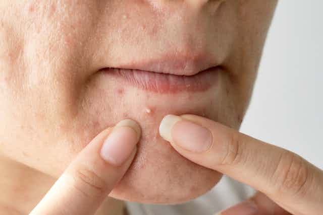 Una persona acerca sus dedos a un grano de acné bajo la boca.