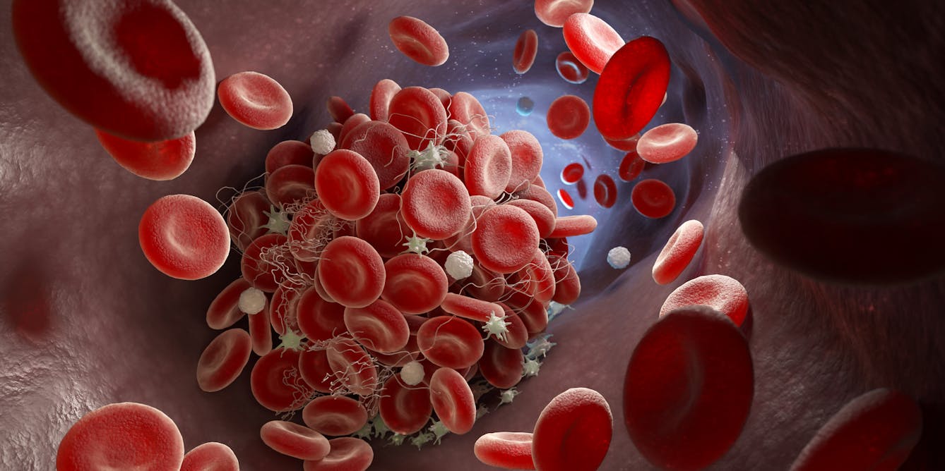 Blood clot risks: comparing the AstraZeneca vaccine and the contraceptive  pill