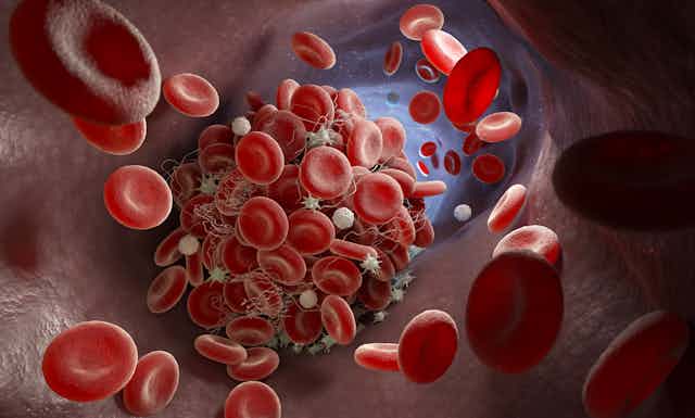 An illustration of a blood clot inside a blood vessel