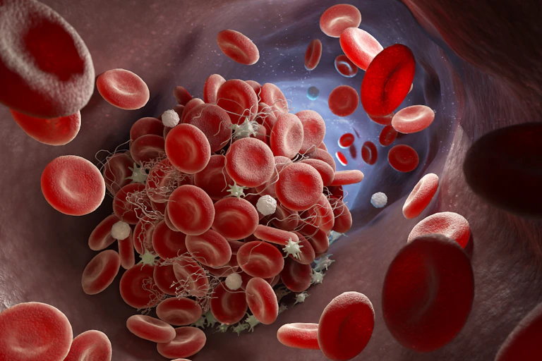 An illustration of a blood clot inside a blood vessel